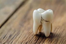 Image result for Tooth Fracture