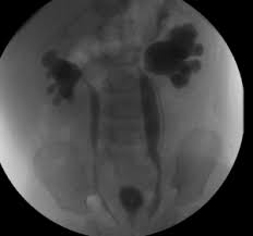 .um.i guess you didn't realize but you. Duplex Collecting System With 2 Ureters On One Side On Vcug American Society Of Pediatric Nephrology Aspn