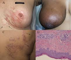 Image result for Inflammatory breast cancer
