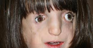 Girl with deformed face learns to navigate world
