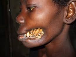 Rarest Diseases Ever 15 Most Horrifying Rare Diseases Nsfl