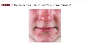 Image result for demodex rosacea