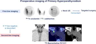Image result for Hyperparathyroidism