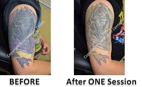 Removal of a tattoo takes time, affords patience, and obviously costs money. Easiest And Hardest Tattoo Colors Laser Tattoo Removal Pristine Laser Center Orlando
