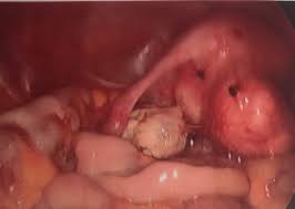 A cyst is a spherical area in any organ in which an outer wall encloses a type of tissue or fluid of a different consistency than ovarian cysts are a very common symptom of endometriosis. Infertility Due To Dermoid Cyst And Fibroid Dr Jenny Cook
