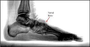 The top countries of suppliers are turkey, china, from. Tarsal Boss Footeducation