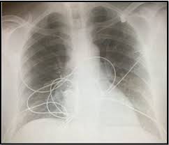 Hypoxia And Normal Chest X Ray In A Young Woman Patient Care Online