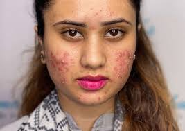 Image result for acne face