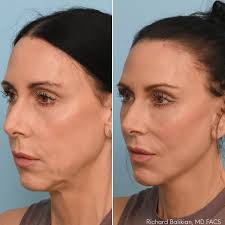 Can you believe these photos are only ONE month apart? 🌟 This patient is  healing incredibly well after Dr. Balikian performed a: