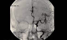 Aneurysma Im Kopf Wann Das Gefahrlich Wird