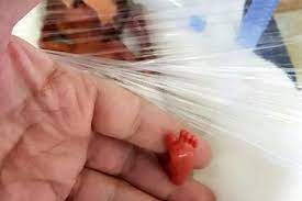 Premature Baby Born Weighing Less Than A Pound Is One Of The Smallest Ever To Survive The Independent The Independent