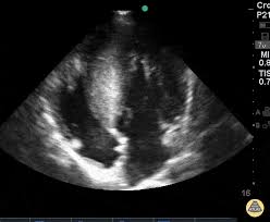 Image result for Left Ventricular Outflow Obstruction