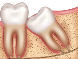 wisdom tooth growing on another tooth
