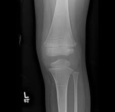 Image result for Osteomyelitis XRay