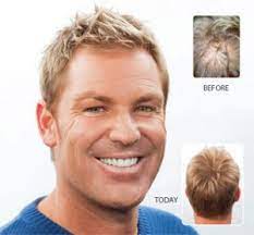 Advanced hair studio provides the best hair replacement treatment, hair loss soluti. Shane Warne Hair Loss Warnie Before And After Results