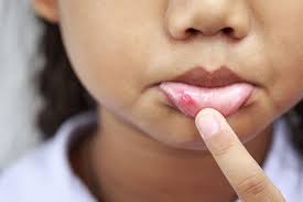 What foods cause cold sores. What Are Canker Sores And Can They Be Prevented