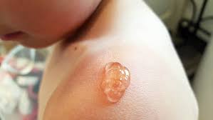 Pour soulager immédiatement le coup de soleil, appliquez de la tomate écrasée mélangée à de la glace pilée sur la zone affectée. Sos Coup De Soleil L Aloe Vera Un Remede Naturel Efficace