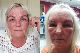 Bristol mum's face balloons with eyebrows 'like two black slugs' after tint  gone wrong at Southmead nail salon