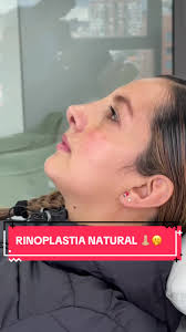 Rinoplastia ultrasónica femenina caso muy complejo por la altura del dorso  nasal sin embargo logramos un hermoso resultado, y mi paciente luce el  perfil que tanto anhelaba. #rinoplastia #rhinoplasty ...