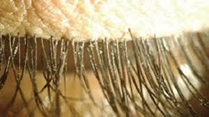 Image result for Demodex folliculorum