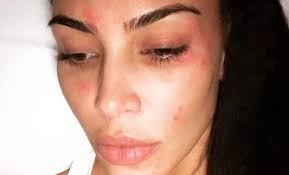 A psoríase tem diversos tipos, sendo que cada um pode levar ao surgimento de sintomas diferentes, além dos citados acima. Psoriase O Que E Sintomas E Tratamento Da Doenca De Kim Kardashian
