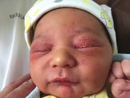 Hsv infections in newborns are usually the result of the virus being passed from mother to baby at the time of delivery. Https Academic Oup Com Pch Article Pdf 22 5 243 23830014 Pxx016 Pdf