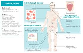 Vit B12 Cobalamin Mangel Medical Knowledge Hashimotos Thyroiditis Glossitis