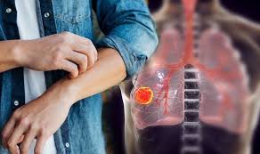 To listen, click the link below. Lung Cancer A Painful And Itchy Rash Known As Dermatomyositis Could Be A Sign Of Disease Express Co Uk