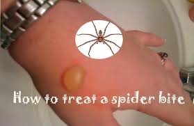 It is very unlikely that you can suffer greatly if they happen to bite the spider will make two pinpricks when they bite. 15 Home Remedies To Treat A Spider Bite Quickly At Home