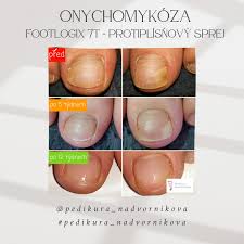 Image result for mykoza nehtů