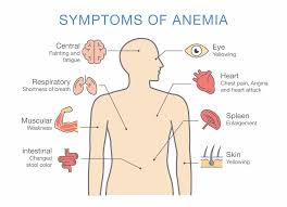 Image result for Anemia simii