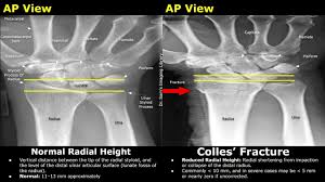 Image result for Wrist XRay