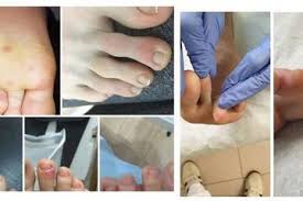 Penyakit ruam kulit gejala penyebab pengobatan klikdokter com. Bintik Merah Corona Ruam Di Kulit Gejala Lain Infeksi Covid 19 Semua Halaman Grid Health