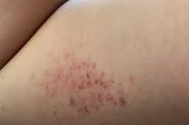 Most petechiae are less than 3 millimeters, or an psoriasis is an inherited, noncontiguous skin disease that begins as red spots on the skin that join together to become larger plaques of thick. Leukemia Symptoms You Shouldn T Ignore The Healthy