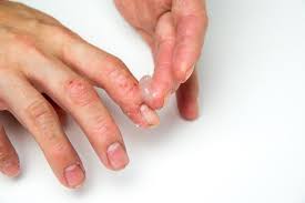 Image result for koebner phenomenon psoriasis