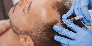 Female pattern hair loss is generally more difficult to treat than androgenetic alopecia in men. Prp For Hair Loss How To Treat Hair Loss Long Term The Derm Dermatologists In Cook County Il