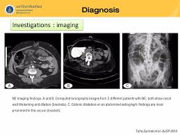 Image result for Neutropenic Colitis