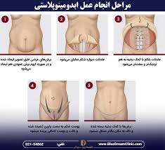 چقدر قبل از عمل نباید سیگار کشید+بعد از عمل ابدو چه لباسی بپوشیم+چرا بعد عمل ابدو شکم ورم دارد+چه مدت بعد از ابدو میتوان سکس داشت