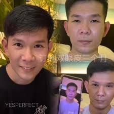 顾客一直觉得鼻子不好看，鼻头大，鼻梁宽，感觉土土的，做的鼻综合+收鼻翼。