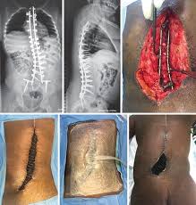 Image result for Spinal Infection