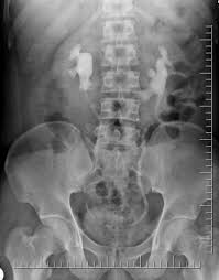 Horseshoe Kidney Radiology Radiology Imaging Medical Illustration