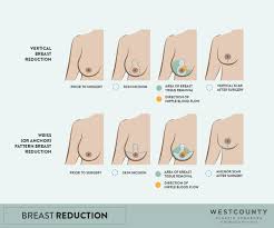 Check spelling or type a new query. Breast Reduction In St Louis Missouri West County Plastic Surgeons