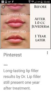 Juvederm Lip Filler 1cc Before After One Year Later Photographs Juvederm Lips Botox Lips Lip Fillers