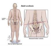Image result for what is current treatment for scoliosis