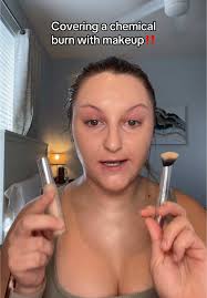 Can I Use Makeup to Cover A Face Chemical Burn
