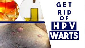Can you get rid of hpv? How To Get Rid Of Hpv Warts Fast 3 Tips You Must Know Youtube