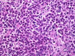Webpathology Com A Collection Of Surgical Pathology Images