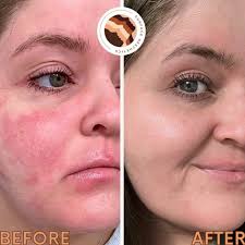 Anti-aging facial with carboxy and v-tox treatment