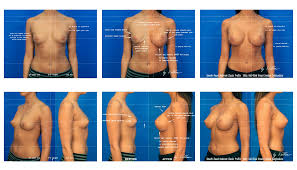 Breast Lift & Reduction Surgery | Villar Plastic Surgery