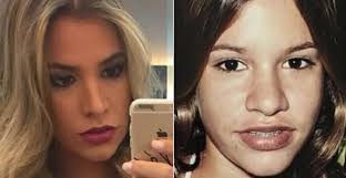 A primeira plástica no nariz de adriana sant'anna foi feita em 2010, antes de sua participação no big brother brasil. Adriana Sant Anna Mostra Foto Antes Da Fama E Surpreende Fas